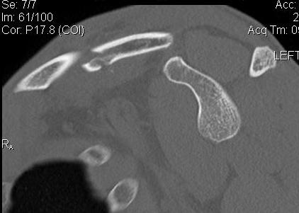 Clavicle Fracture CT